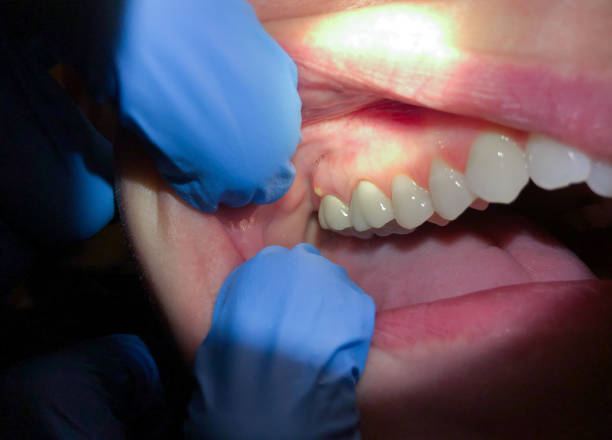 Best Urgent Tooth Repair  in Santa Moni, CA